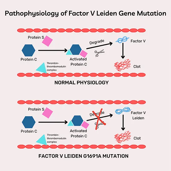 factor v leiden mutation analysis